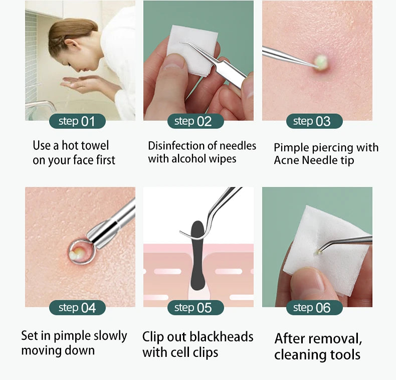 Clear Skin Essentials: Stainless Steel Acne & Blackhead Removal Kit