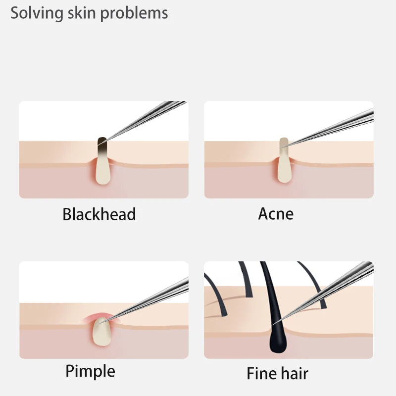 Clear Skin Essentials: Stainless Steel Acne & Blackhead Removal Kit